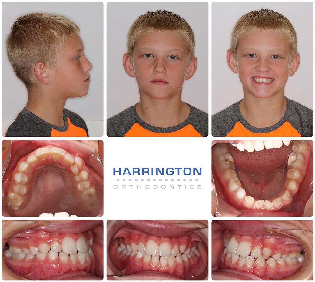 Lower Canine Impacted - Harrington