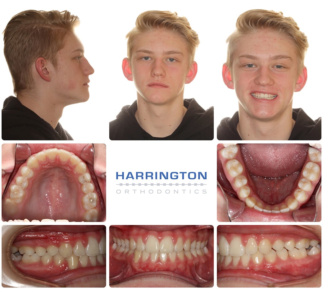 Lower Canine Impacted - Harrington