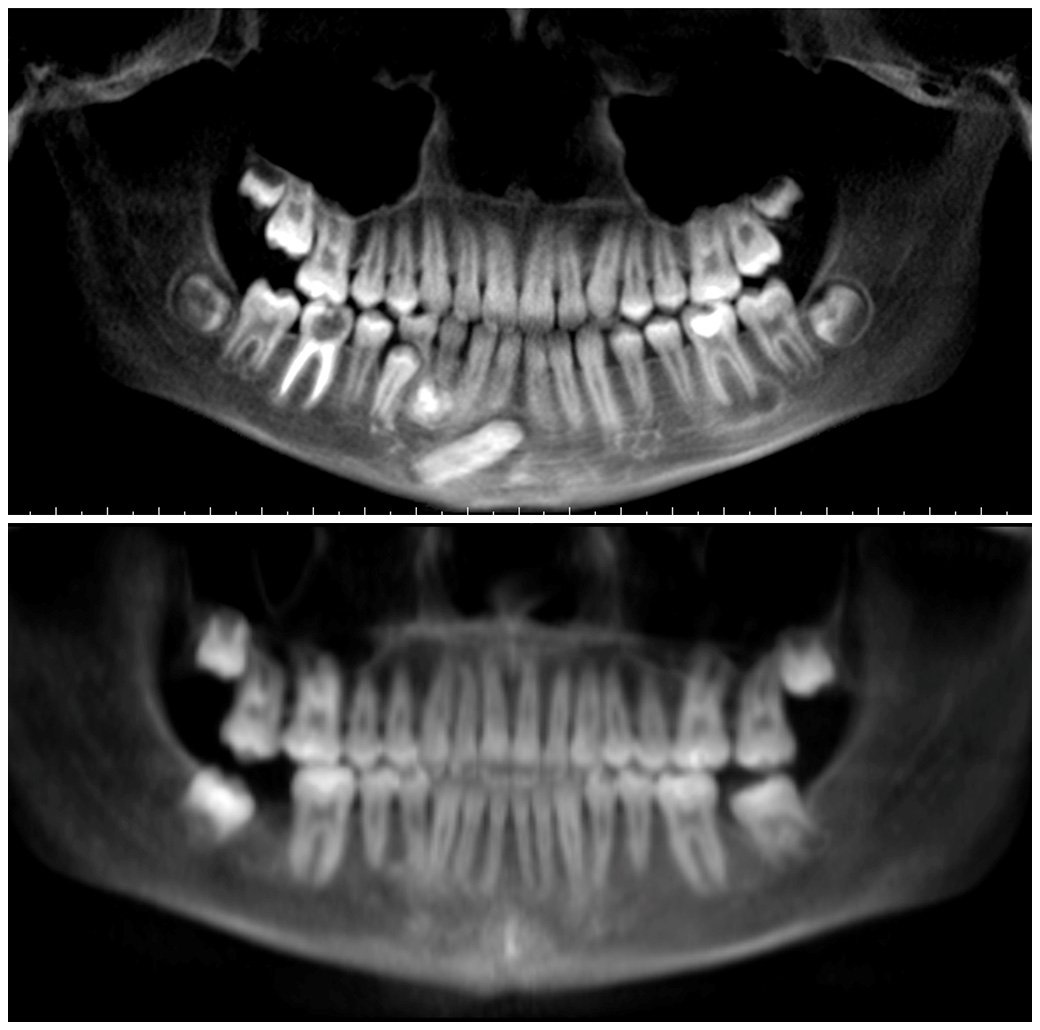 Lower Canine Impacted - Harrington