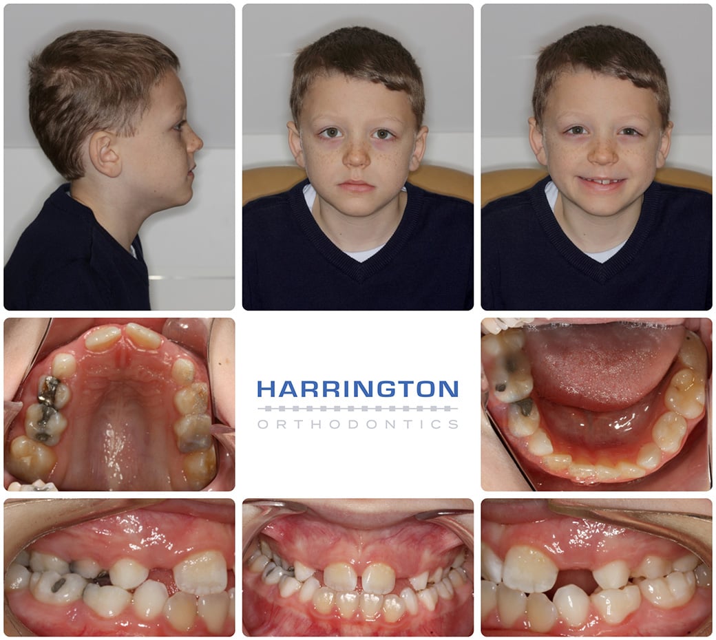 crossbite braces before after