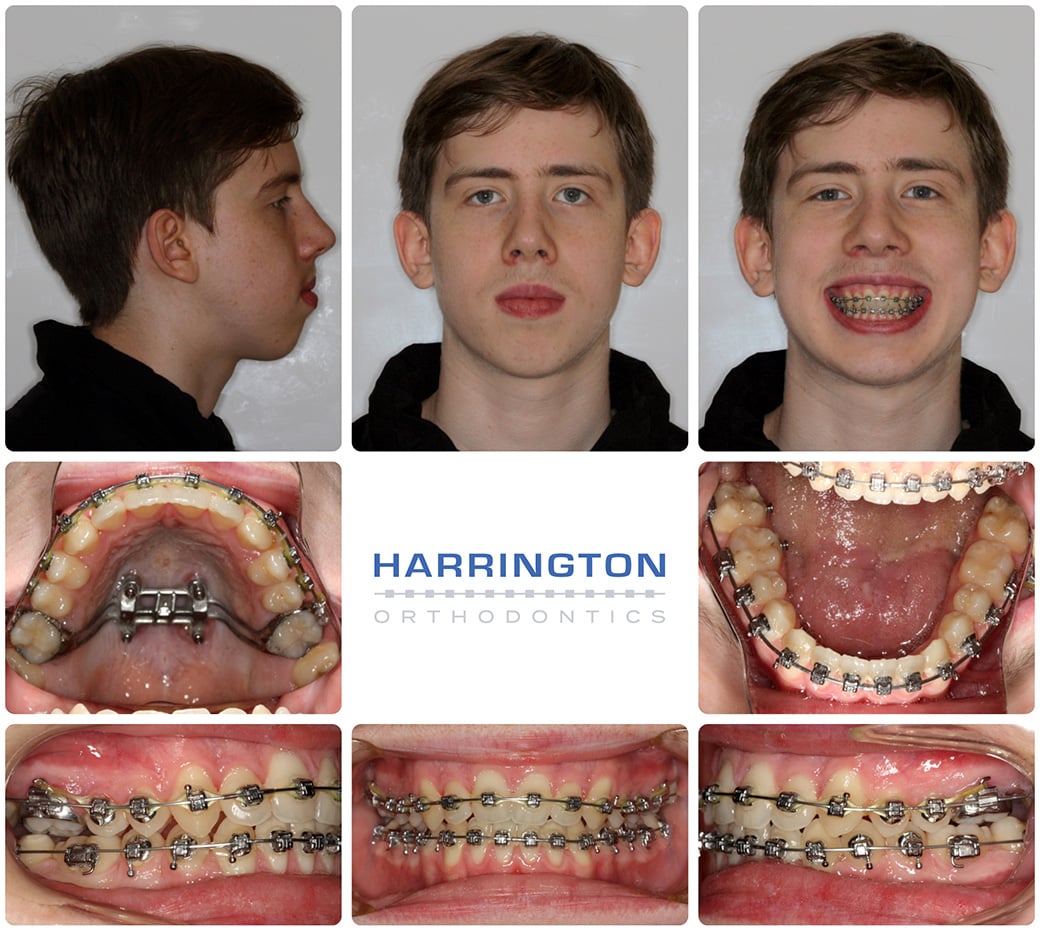 https://harringtonorthodontics.com/wp-content/uploads/2021/06/img-casestudy-surgicalmoon-02.jpg